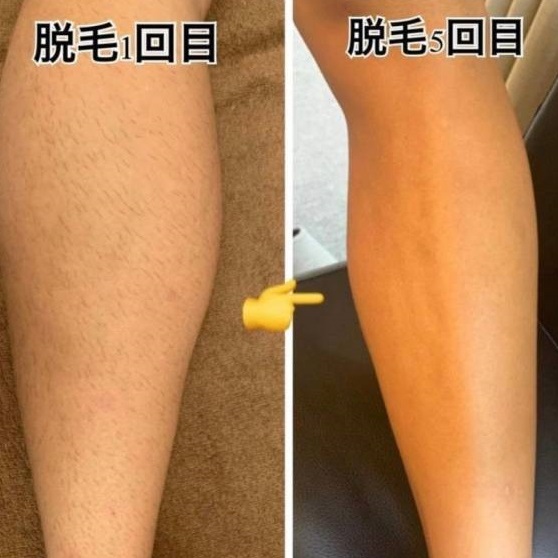 ふくらはぎ脱毛
